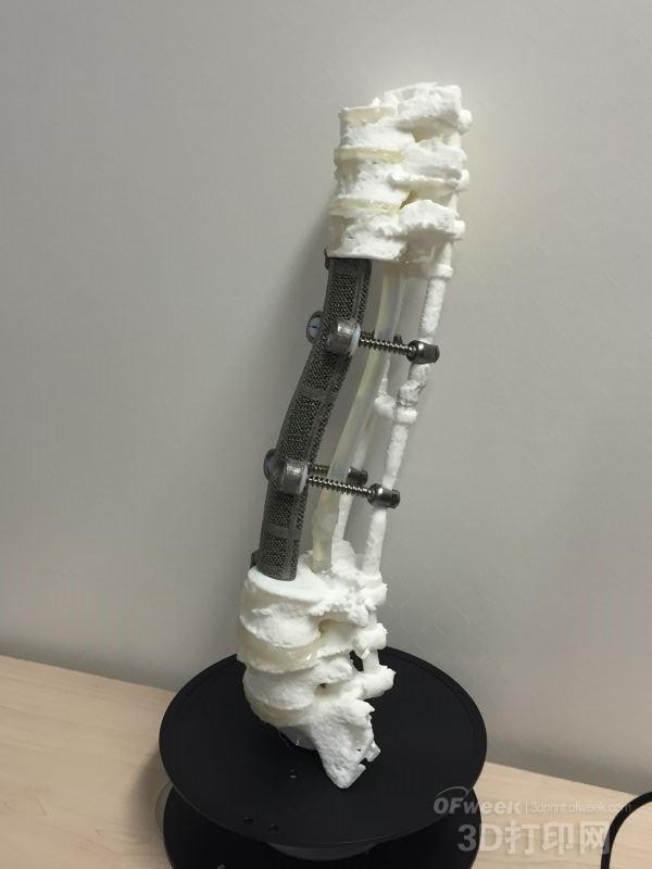 The world's first 3D printed custom artificial vertebral body implant