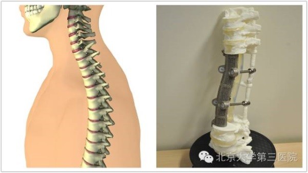 The world's first 3D printed custom artificial vertebral body implant