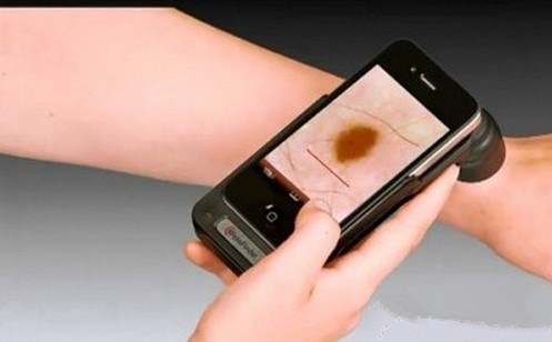 Smartphone can diagnose skin cancer