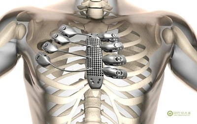 The first cancer patient successfully implanted 3D printed sternum and ribs