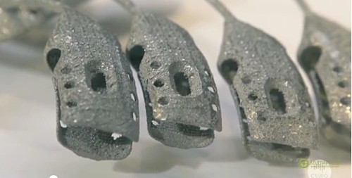 The first cancer patient successfully implanted 3D printed sternum and ribs