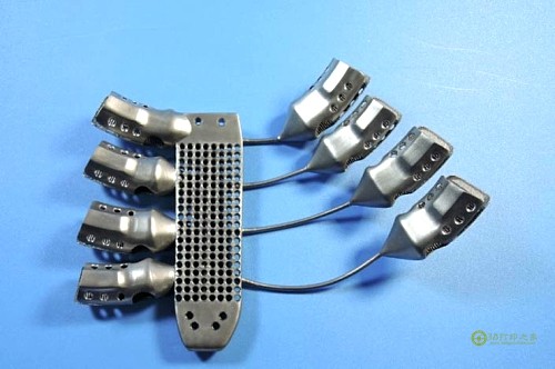 The first cancer patient successfully implanted 3D printed sternum and ribs