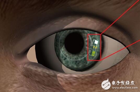 After Google, another blood glucose sensor smart contact lens