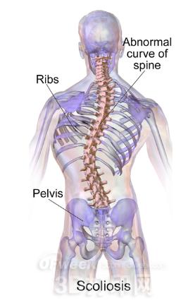 India uses medical 3D printing technology to assist in correcting scoliosis