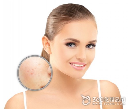 Pustule acne acne pus acne inflammation