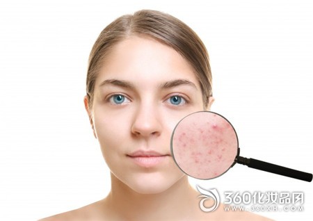 Pustule acne acne pus acne inflammation