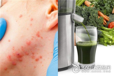 Long acne adolescence blackhead egg yolk honey protein