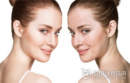 Pustule acne acne pus acne inflammation