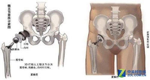 Why is 3D printing the life-saving straw on the operating table?