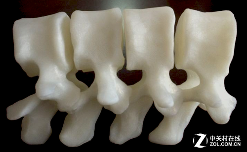 Since the implanted 3D spine fits well with the surrounding bones, it does not require too much anchoring. In addition, the researchers have set up micropores on it, which can help bones grow between alloys. In other words, the implanted 3D printed spine will grow firmly with the original spine, which means that the future will not There will be loose conditions.