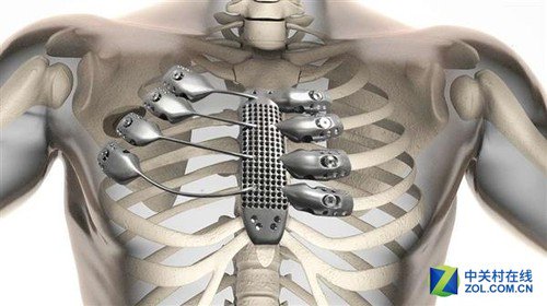 3D printed titanium alloy chest rib structure