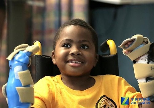 Currently, Zion is undergoing routine professional treatment to restore hand function and continue to detect any signs of possible rejection. This is the world's first child's two-hand transplant surgery and has achieved great success.
