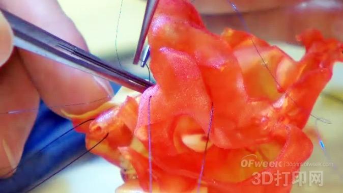Toronto Children's Hospital officially applied 3D printed organ model surgery