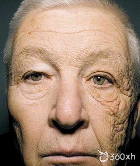 Sun protection can not be less on cold winter days