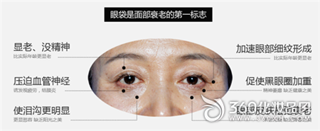 Blinking bags, incision bags, the United States, Ningbo Plastic Surgery Hospital, no traces, eye bags 1