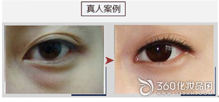 Blinking bags, incision bags, Meilai Ningbo Plastic Surgery Hospital, no traces, eye bags 4