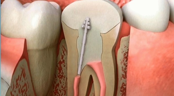 You don't have to pull your teeth, your teeth are expected to regenerate.