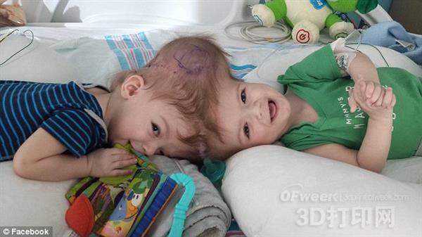 Medical 3D printing technology helps surgeons separate conjoined twins