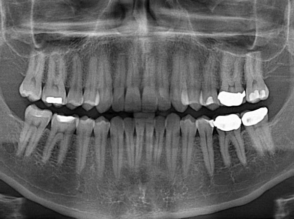 You don't have to pull your teeth, your teeth are expected to regenerate.