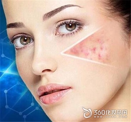 Acne, face, potato, ecological balance, sterilization, anti-inflammatory, control of infection