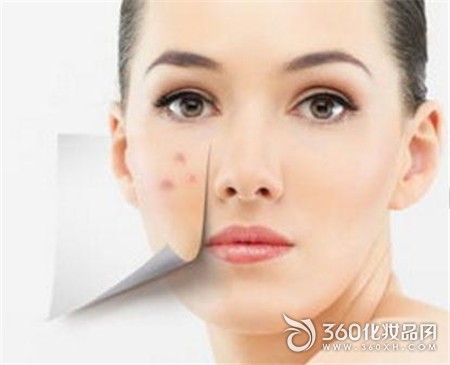 Acne, face, potato, ecological balance, sterilization, anti-inflammatory, control of infection