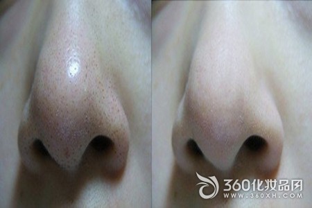 Nose blackhead squeeze blackhead toner cleansing oil