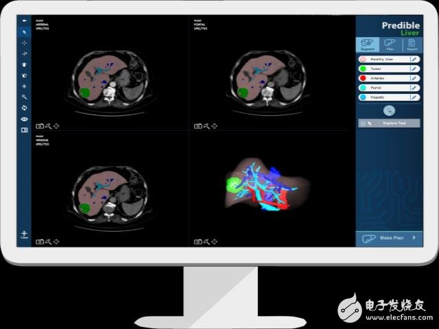 Predible Health: Providing treatment options for doctors with AI and cloud computing