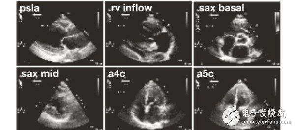 Researchers use AI to analyze cardiac scan tasks. Accuracy beat human cardiologists