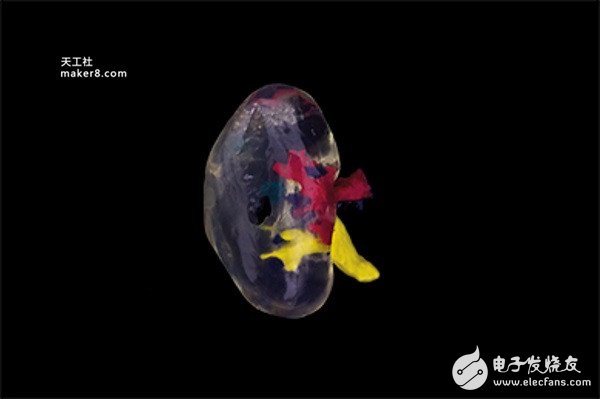 The first case in the UK: a complex kidney transplant with a 3D printed model