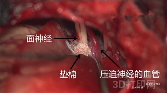 Latest research: 3D printing technology can be used for minimally invasive surgery