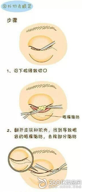 The picture reveals the four methods of micro-shaping to the eye bags 1