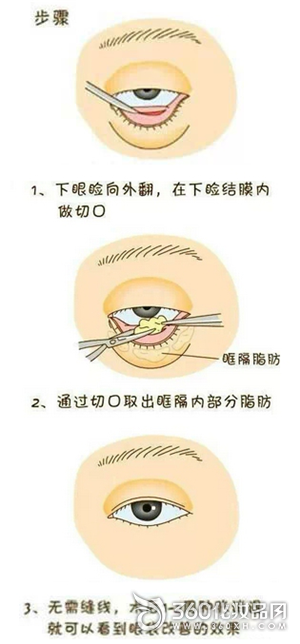 The picture reveals the four methods of micro-shaping to the eye bags 2