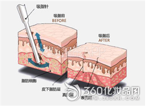 The picture reveals four methods of micro-shaping to the eye bags 4