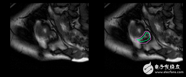 Deep learning how to perform right ventricular segmentation in MRI images