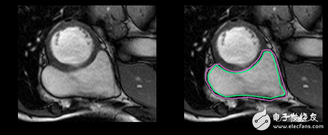 Deep learning how to perform right ventricular segmentation in MRI images