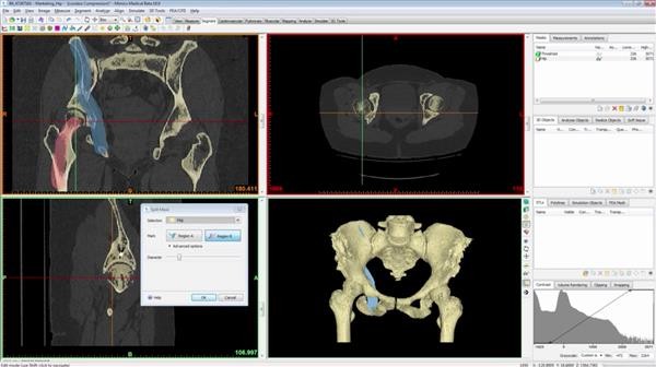 Materialise releases the latest version of Mimics, a medical 3D imaging software package