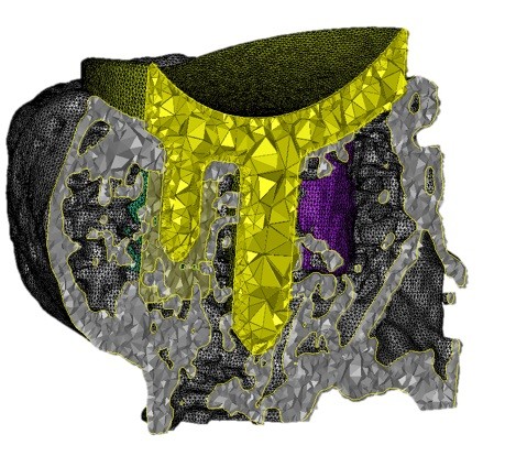 Materialise releases the latest version of Mimics, a medical 3D imaging software package