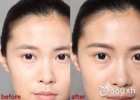Before and after the thrush