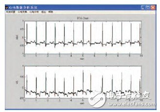 Design of wearable ECG monitoring system based on biofeedback technology
