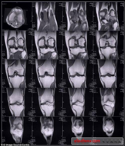 Experts say the knee joint is unique and can be used for identification