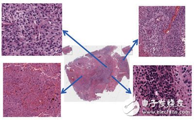 Researchers have developed methods that can automatically analyze a large number of tumor images