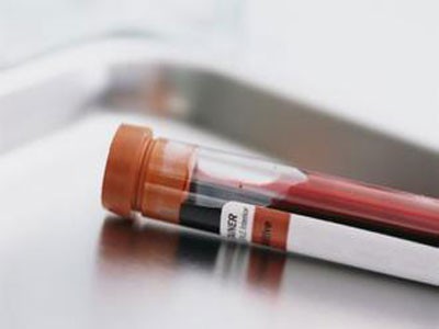 A blood test can show if heart disease will occur within 5 years