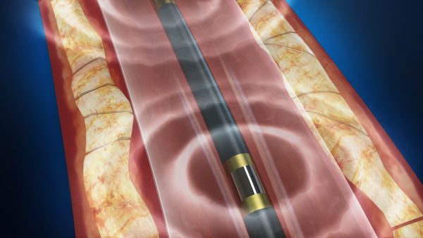 Medical Technology Innovation: Lithoplasty uses acoustic wave technology to revolutionize cardiovascular care