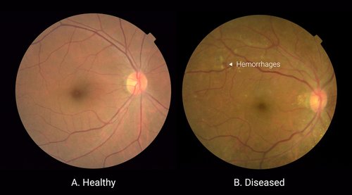 Google uses neural network algorithm to detect diabetic retinopathy