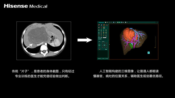 æµ·ä¿¡åŒ»ç–—é™ˆæ°¸å¥ï¼šäººå·¥æ™ºèƒ½è¾…åŠ©ç²¾å‡†æ‰‹æœ¯