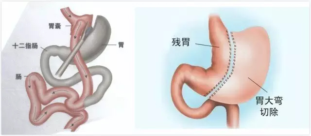 æ•°å­—åŒ»ç–—ä¸´åºŠè¯•éªŒè¯æ˜ŽIIåž‹ç³–å°¿ç—…å¯é€†è½¬