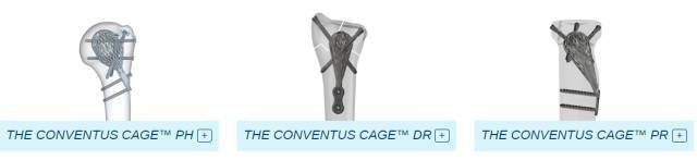 Conventus Orthopaedicsç ”å‘3Déª¨æŠ˜ä¿®å¤æ¤å…¥è®¾å¤‡ï¼šèŽ·2000ä¸‡ç¾Žå…ƒèžèµ„