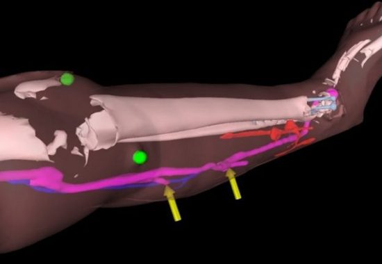 åœ¨å¾®è½¯ HoloLens ååŠ©ä¸‹ï¼Œè‹±å›½å›¢é˜Ÿè®©å¤–ç§‘åŒ»ç”Ÿèƒ½â€œé€è§†â€æ‰‹æœ¯éƒ¨ä½è¿›è¡Œè¡€ç®¡é‡å»º