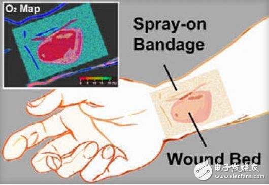 "Smart Bandage" that monitors real-time wounds/accelerated wound healing