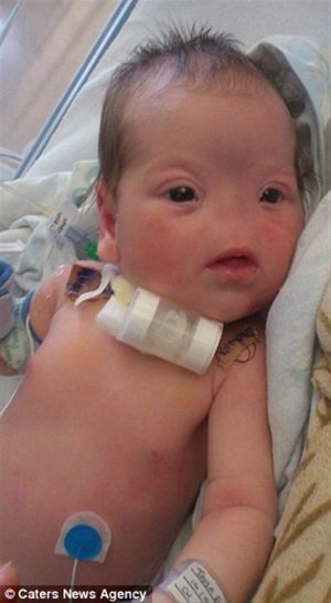 è‹±å›½é¦–ä¾‹3Dæ‰“å°é¼»å­æˆåŠŸæ¤å…¥ä¸¤å²å°å¥³å­©è„¸ä¸Š